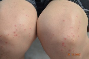 mosquito beaten knees